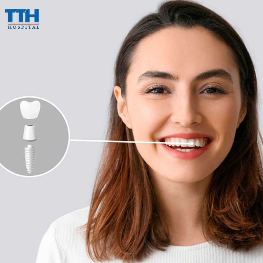Những Hiểu Lầm Phổ Biến Về Trồng Răng Implant