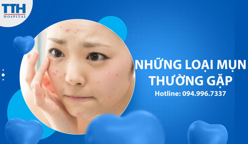 Những loại mụn thường gặp