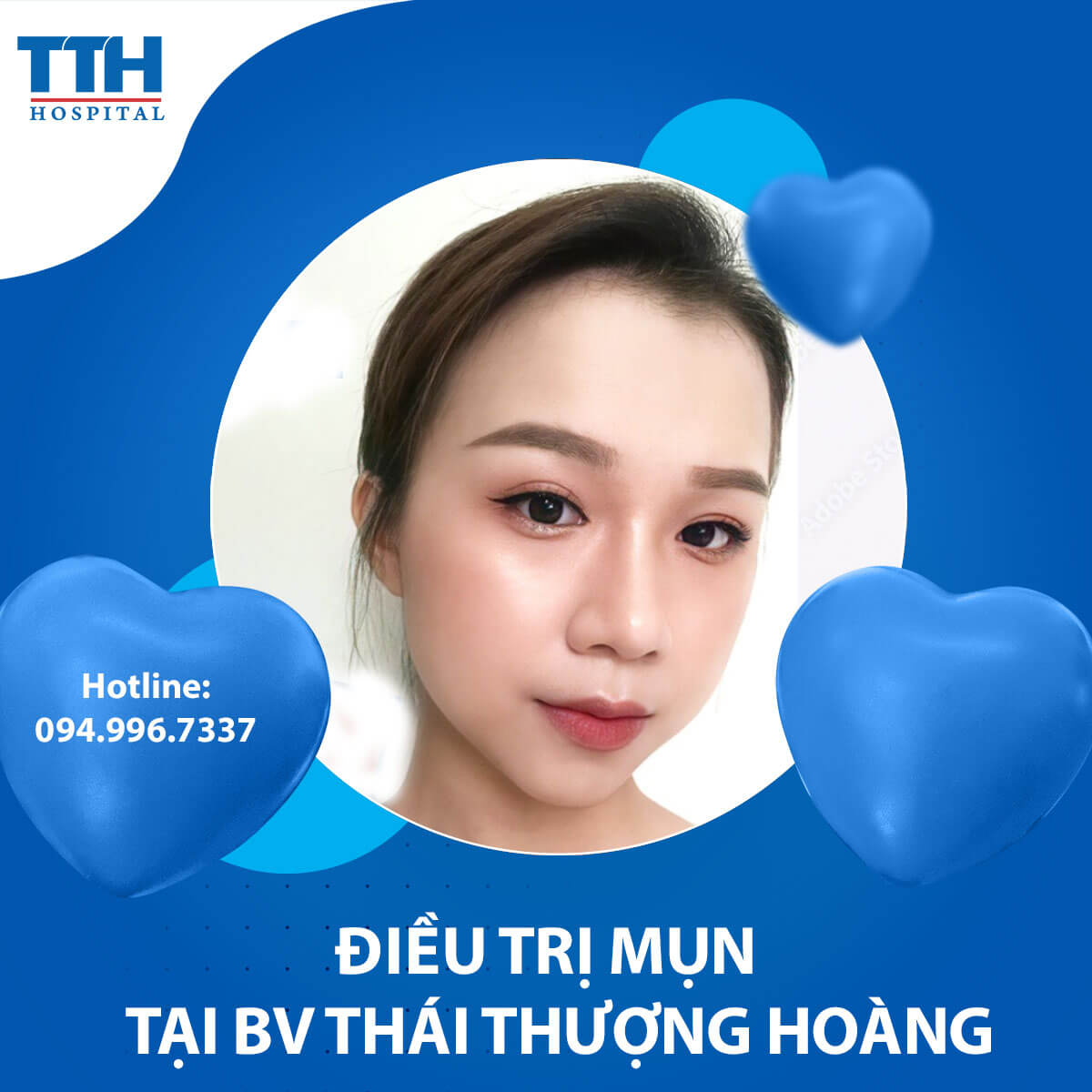 Những loại mụn thường gặp