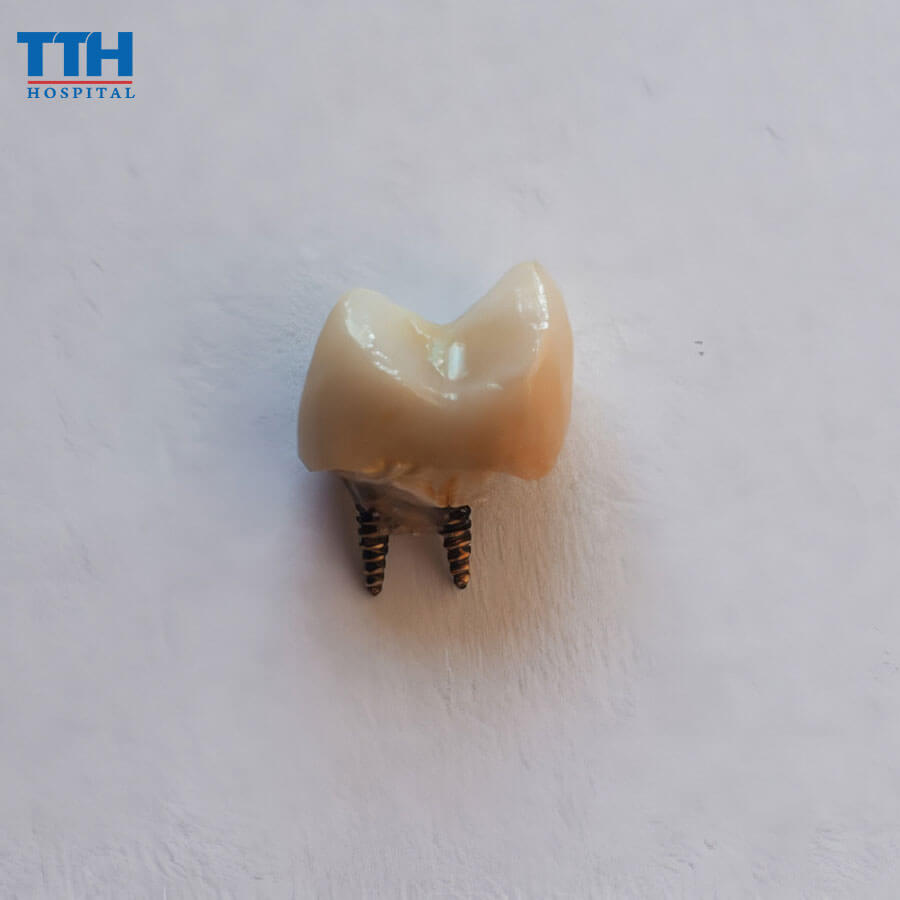 Những Sai Lầm Phổ Biến Khi Trồng Răng Implant Và Cách Tránh