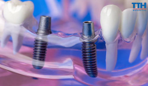 Những Sai Lầm Phổ Biến Khi Trồng Răng Implant Và Cách Tránh
