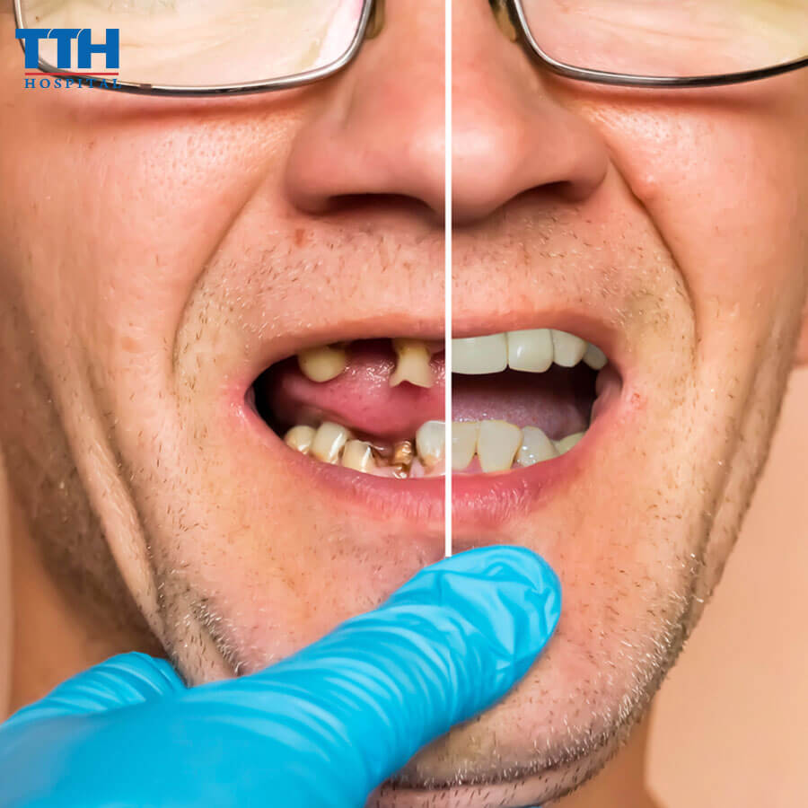 Những Trường Hợp Nào Không Nên Trồng Răng Implant?