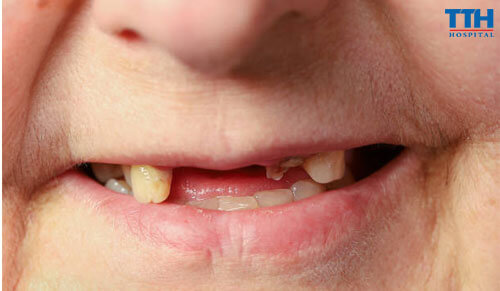 Những Trường Hợp Nào Không Nên Trồng Răng Implant?