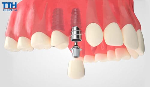 Quy trình trồng răng Implant từ A đến Z tại Bệnh viện Thái Thượng Hoàng