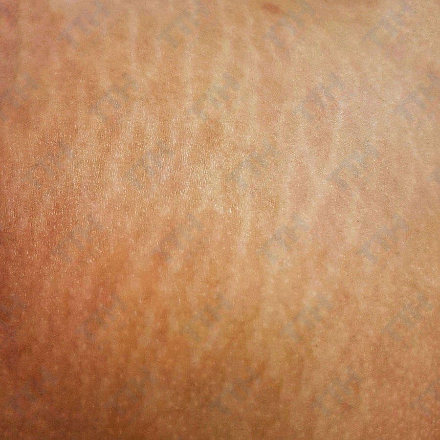 Rạn da ở nam giới: Nguyên nhân, cách phòng ngừa và điều trị hiệu quả