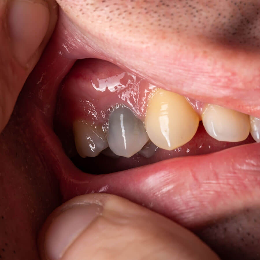 Răng chết tủy sống được bao lâu? Những điều bạn cần biết