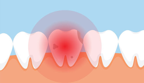 Răng chết tủy sống được bao lâu? Những điều bạn cần biết