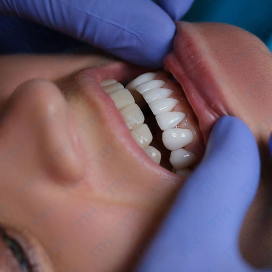 Răng Sứ Diamond Veneer – Giải Pháp Thẩm Mỹ Đỉnh Cao Hay Chỉ Là Quảng Cáo?