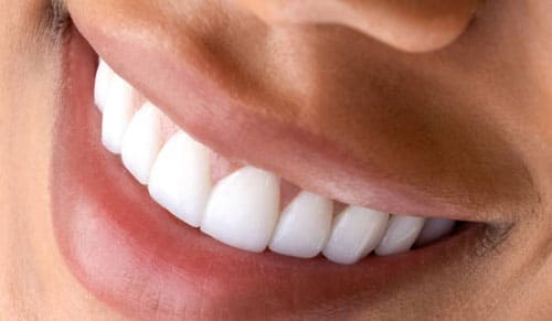 Răng Sứ Diamond Veneer – Giải Pháp Thẩm Mỹ Đỉnh Cao Hay Chỉ Là Quảng Cáo?