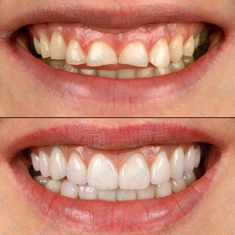 Răng sứ Noritake là gì?