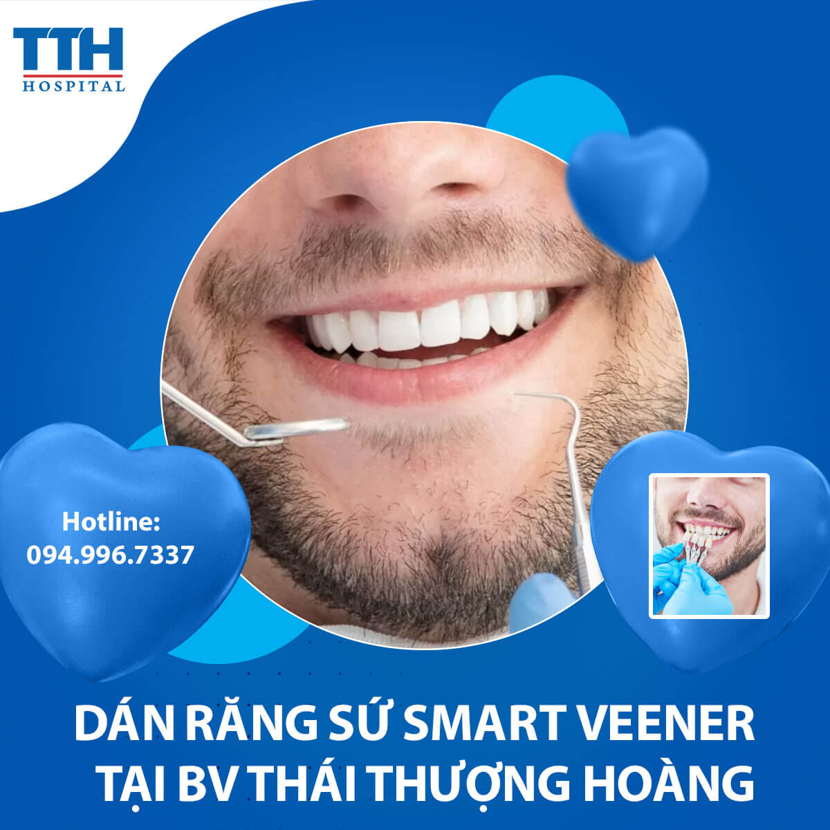 Răng Sứ Diamond Veneer và những điều cần biết