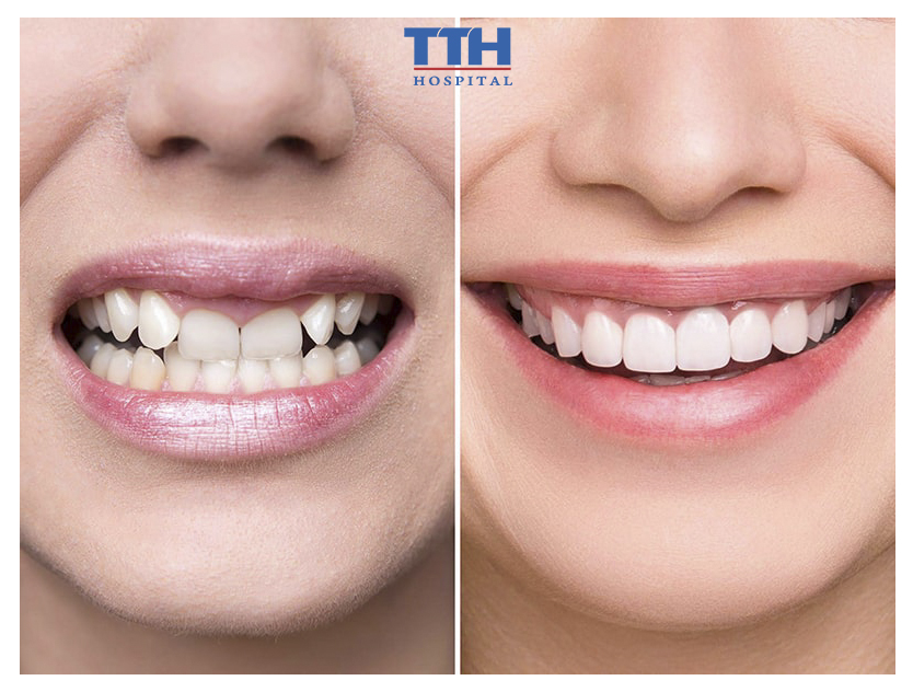 Trường hợp nào nên bọc răng sứ? Bọc răng sứ ở đâu tốt?