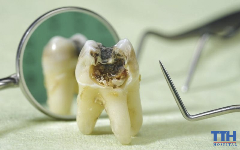 BIẾN CHỨNG CỦA SÂU RĂNG CÓ THỂ GẶP PHẢI