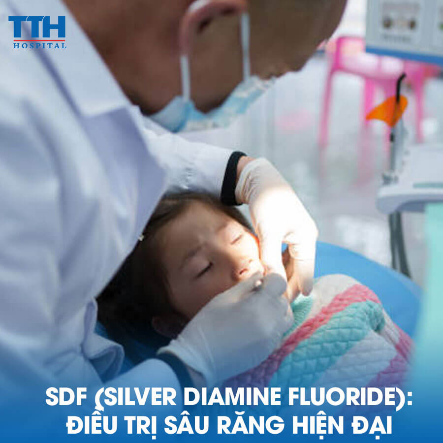 SDF (Silver Diamine Fluoride): Phương Pháp Điều Trị Sâu Răng Hiện Đại