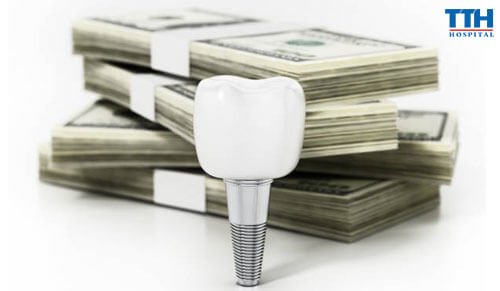 So Sánh Chi Phí Trồng Răng Implant Giữa Các Quốc Gia