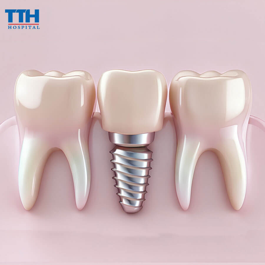 So Sánh Răng Implant Và Răng Giả: Lựa Chọn Nào Tốt Hơn?