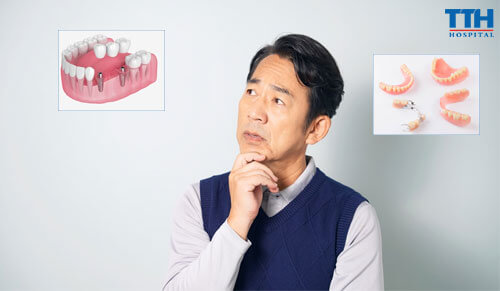 So Sánh Răng Implant Và Răng Giả: Lựa Chọn Nào Tốt Hơn?