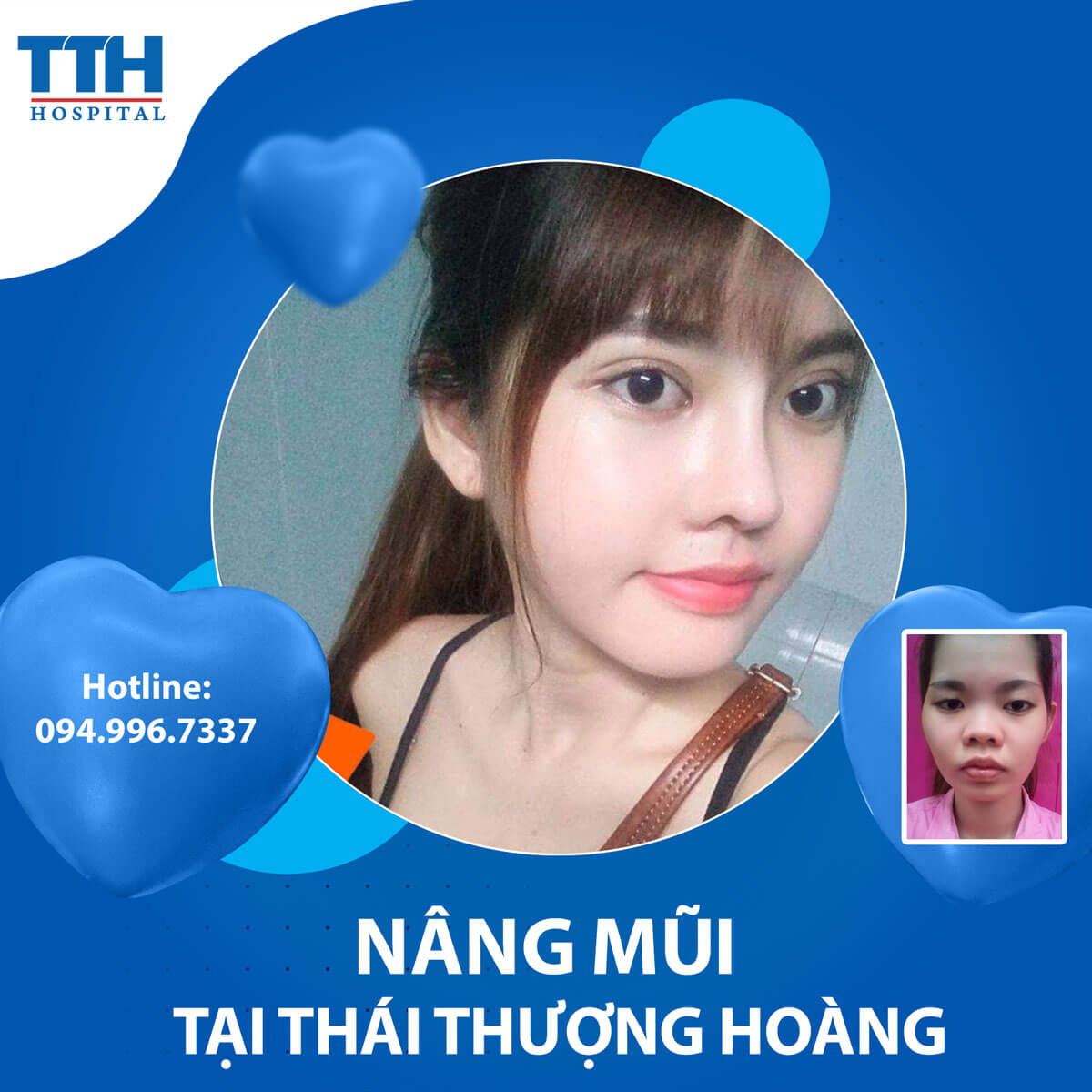 Top 5 dáng mũi đẹp năm 2023