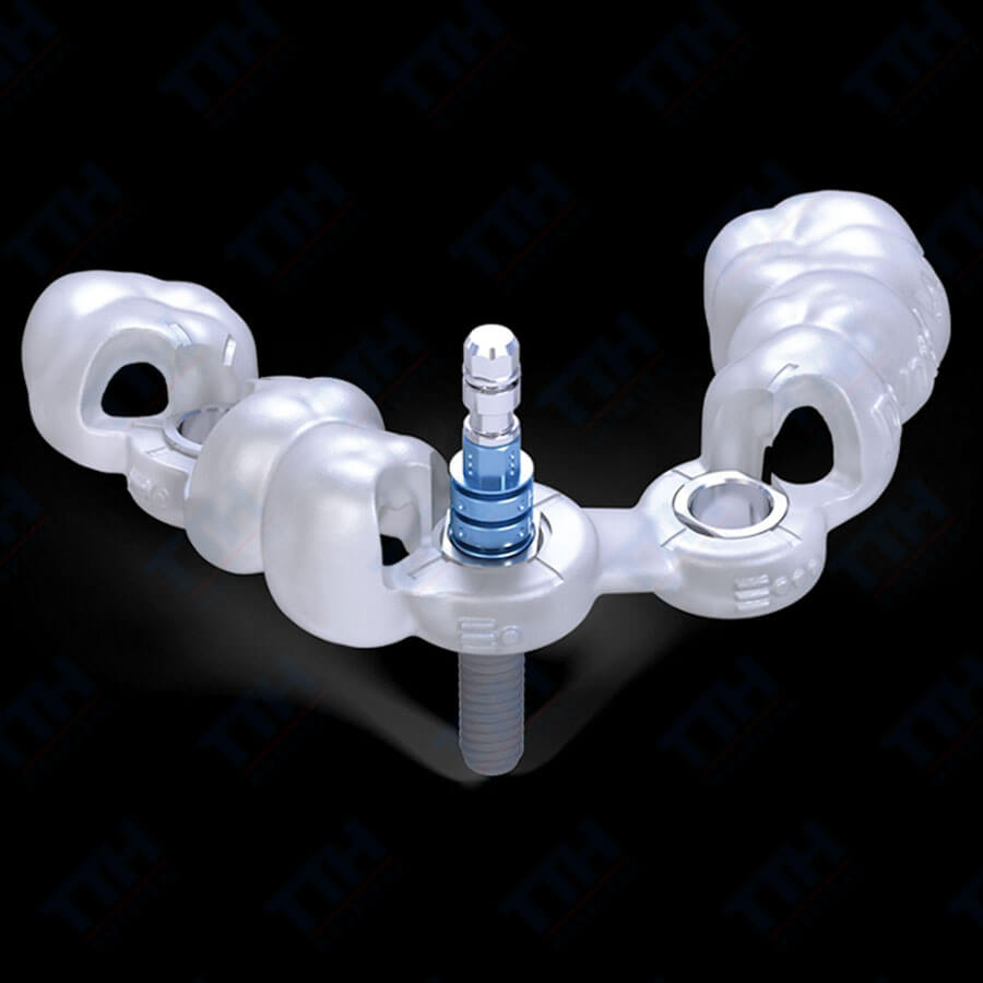 Tại Sao Nên Sử Dụng Máng Hướng Dẫn Phẫu Thuật Trong Cấy Ghép Implant?