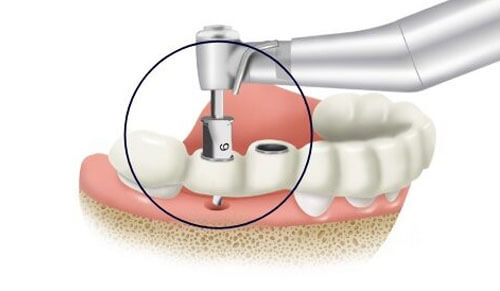 Tại Sao Nên Sử Dụng Máng Hướng Dẫn Phẫu Thuật Trong Cấy Ghép Implant?