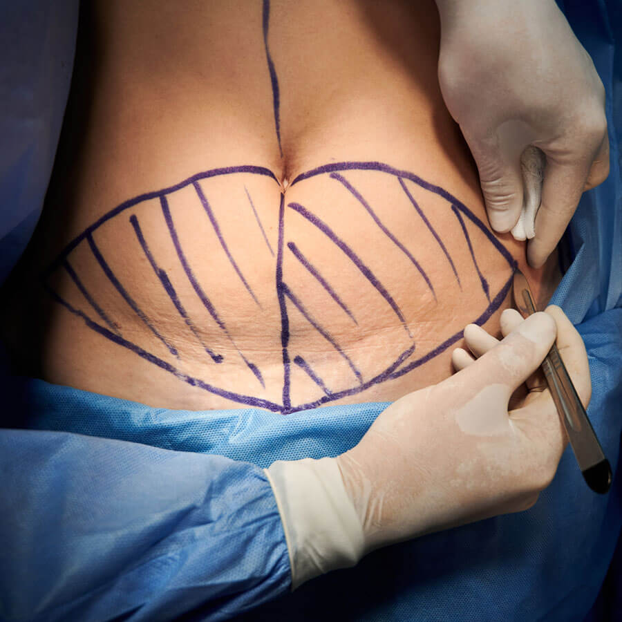 Tạo Hình Bụng Bán Phần: Giải Pháp Cho Vùng Bụng Thừa Da, Chảy Xệ