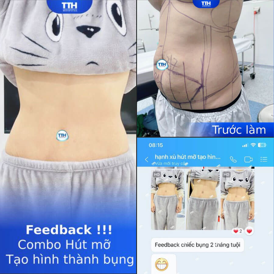 Tạo hình thành bụng tại Nghệ An và những điều cần biết