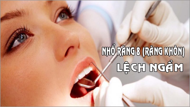 Nhổ răng số 8