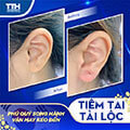 Tiêm tai tại bệnh viện Thái Thượng Hoàng