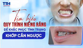 Tìm hiểu quy trình niềng răng để khắc phục tình trạng khớp cắn ngược