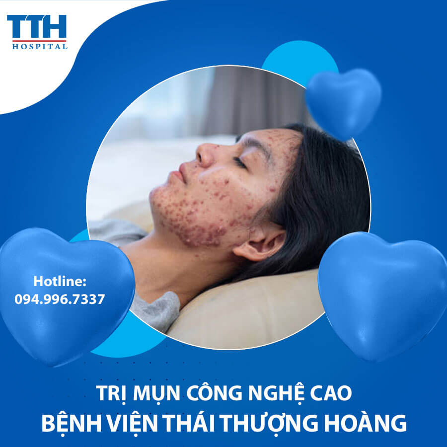 Trị mụn công nghệ cao