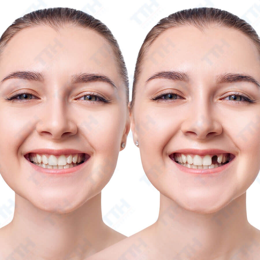 Trồng Răng 1 Cái Bao Nhiêu Tiền: Chi Phí và Những Điều Cần Biết