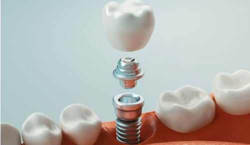 Trồng Răng 1 Cái Bao Nhiêu Tiền: Chi Phí và Những Điều Cần Biết