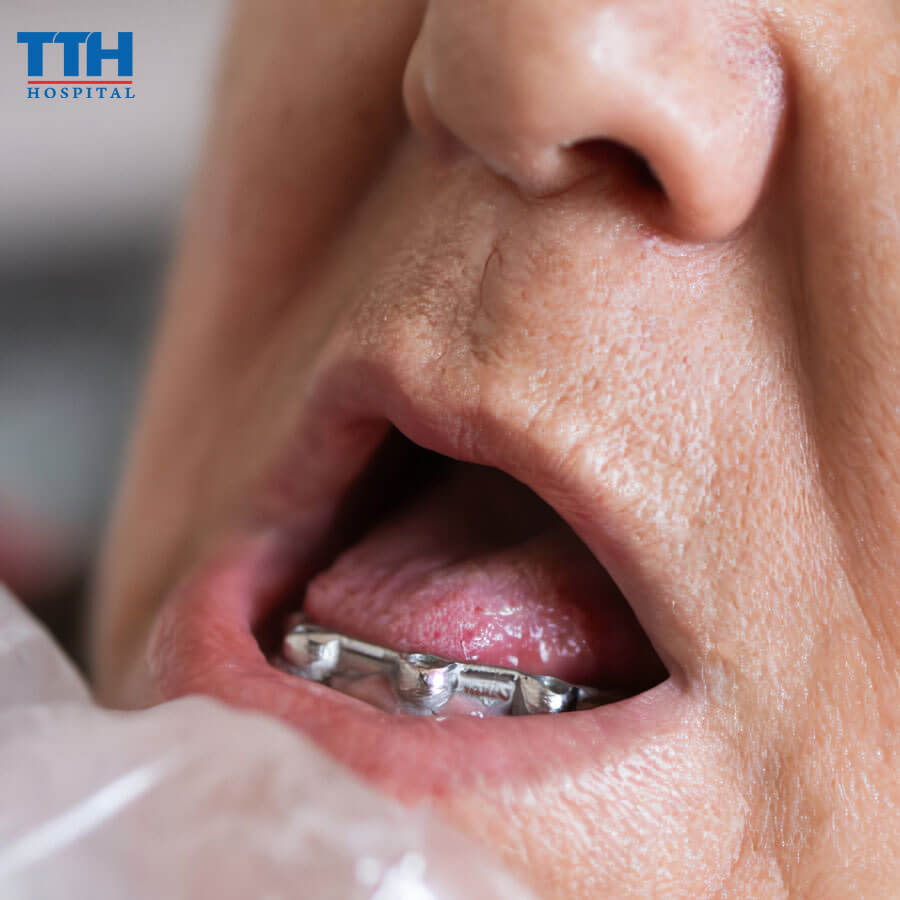 Trồng Răng Implant Có Đau Không? Giải đáp thắc mắc