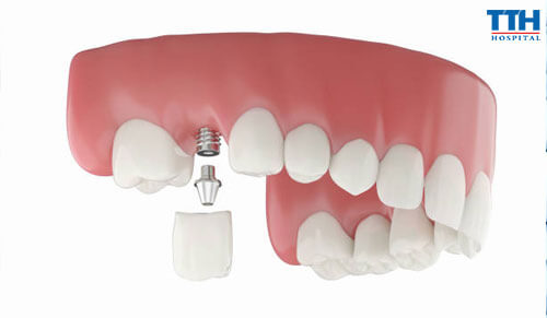 Trồng Răng Implant Có Đau Không? Giải đáp thắc mắc