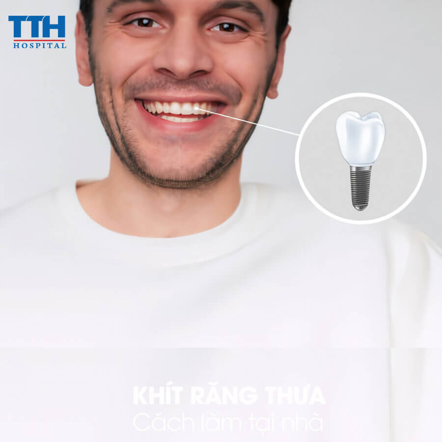 Trồng Răng Implant Có Tuổi Thọ Bao Lâu?