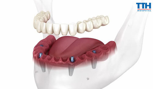 Trồng Răng Implant Có Tuổi Thọ Bao Lâu?