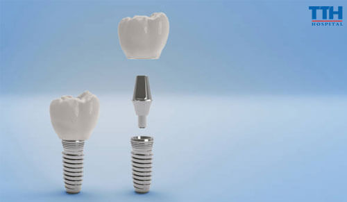 Trồng Răng Implant: Giải Pháp Hiệu Quả Cho Người Mất Răng