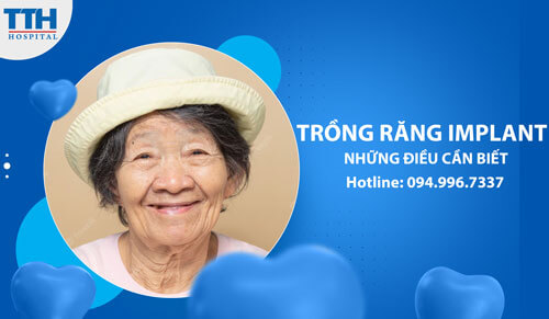 Trồng Răng Implant và Những Điều cần biết trước khi làm