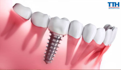 Trồng Răng Implant Ở Người Bị Loãng Xương
