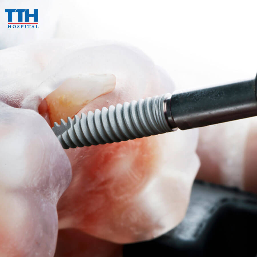 Trồng Răng Implant: Quy Trình Và Thời Gian Hồi Phục