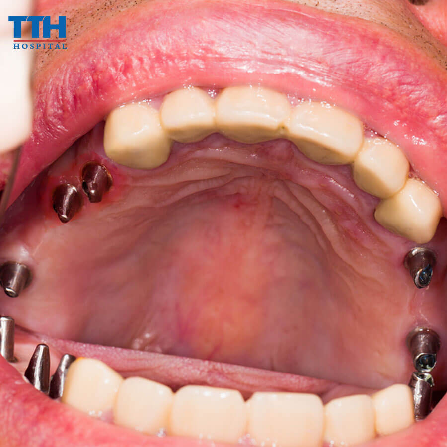 Trồng Răng Implant Trong Các Trường Hợp Dị Ứng Với Kim Loại