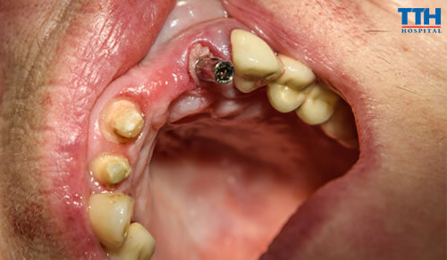 Trồng Răng Implant Trong Các Trường Hợp Dị Ứng Với Kim Loại