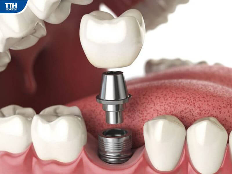 Trồng răng implant và tất tần tật những điều cần biết