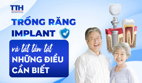 Trồng răng implant và tất tần tật những điều cần biết