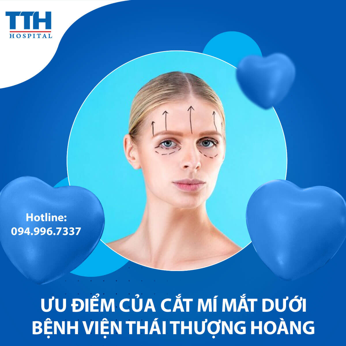 Ưu Điểm Của Cắt Mí Mắt Dưới