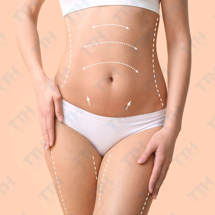 Ưu Điểm và Lợi Ích Của Phẫu Thuật Tạo Hình Bụng Bán Phần: Giải Pháp Hoàn Hảo Cho Vùng Bụng Săn Chắc