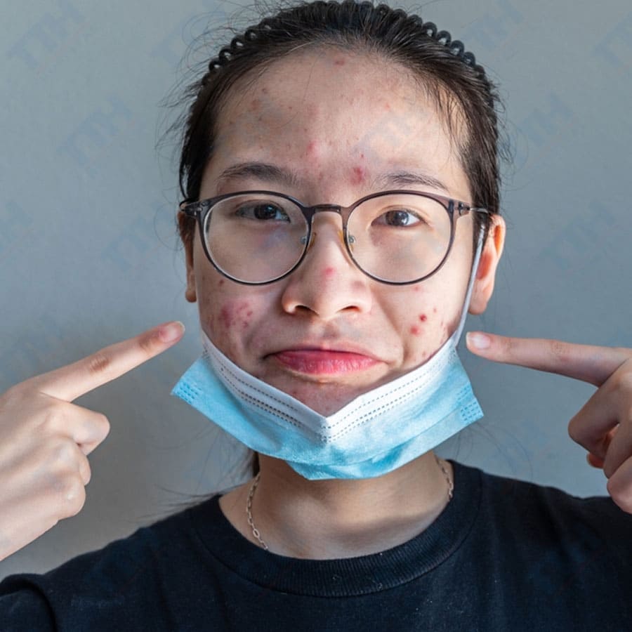 Vì Sao Da Dễ Nổi Mụn Hơn Vào Dịp Cuối Năm?