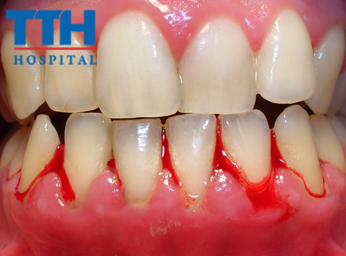 Điều trị Viêm nướu/ Nha chu