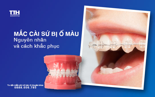 Mắc cài sứ bị ố màu - Nguyên nhân và cách khắc phục