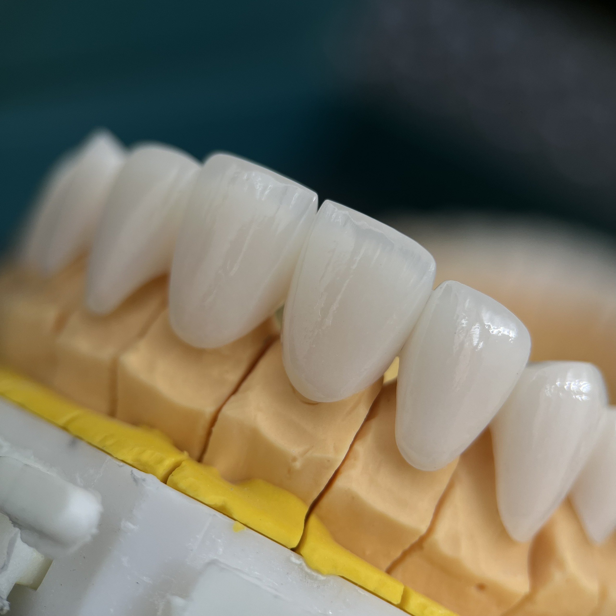 Bọc Răng Sứ Có Lấy Cao Răng Được Không?